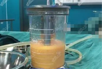 恩施360度水动力吸脂费用多少钱？