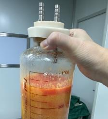 恩施水动力吸脂手术要做多久？
